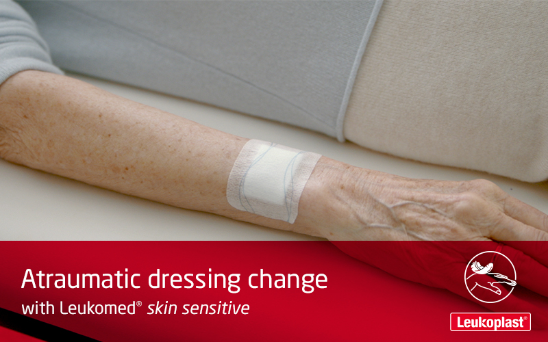 This video demonstrates how dressings can be removed from fragile skin without skin tears. An HCP is shown painlessly peeling a Leukomed skin sensitive dressing from an elderly woman's arm and applying a new Leukomed skin sensitive on the wound. This video demonstrates how dressings can be removed from fragile skin without skin tears. An HCP is shown painlessly peeling a Leukomed skin sensitive dressing from an elderly woman's arm and applying a new Leukomed skin sensitive on the wound.